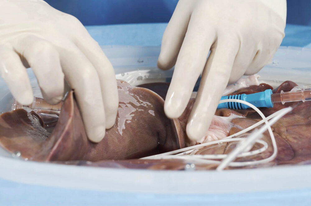 Xvivo Machine Perfusion